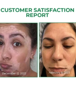 Lovilds™ VitiligoFix Revitalize Elixir