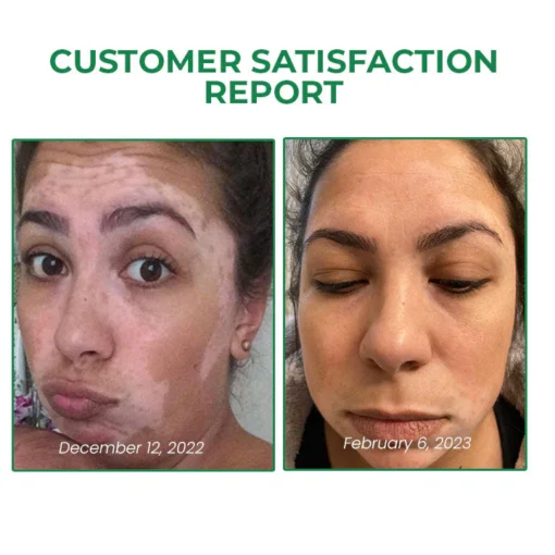 Lovilds™ VitiligoFix Revitalize Elixir
