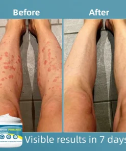 Negusy™ Multi-Symptom Psoriasis Treatment Cream