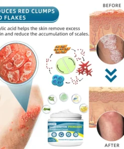 Negusy™ Multi-Symptom Psoriasis Treatment Cream