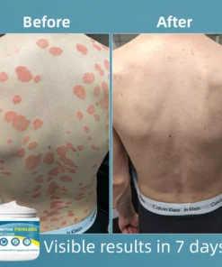 Ourlyard™ Multi-Symptom Psoriasis Treatment Cream