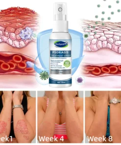 Ourlyard™ Psoriasis Treatment Spray