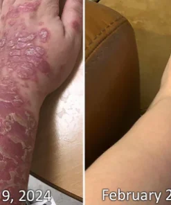 كريم سم النحل AQA™ PsoriX