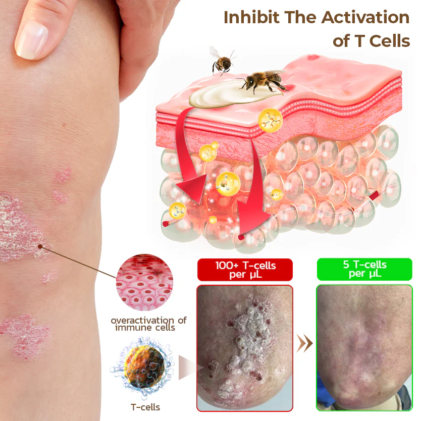 GFOUK™ PsoriX Bee Venom Cream