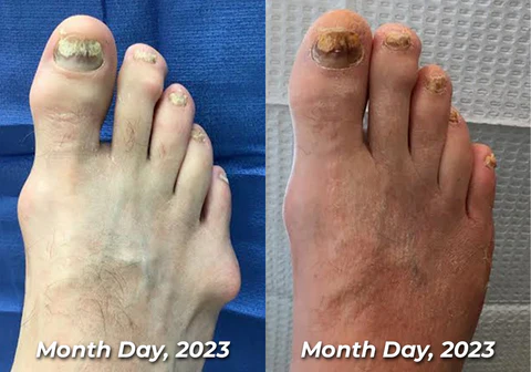 flysmus™ HalluxCare Bee Venom Treatment Cream