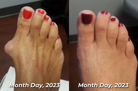 flysmus™ HalluxCare Bee Venom Treatment Cream