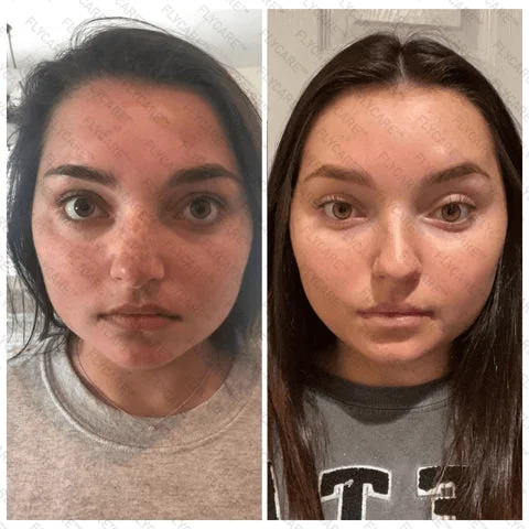 FLYCARE™ Snake Venom Vitiligo Treatment Cream
