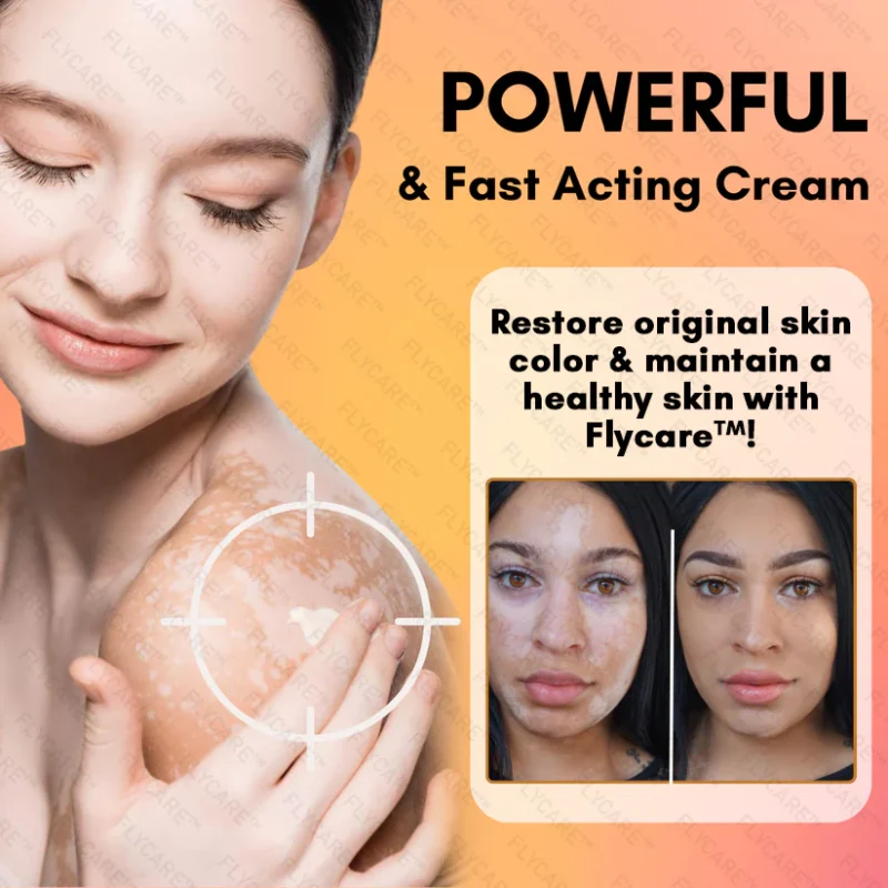 FLYCARE™ Snake Venom Vitiligo Treatment Cream