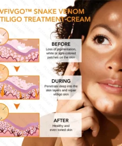 FLYCARE™ Snake Venom Vitiligo Treatment Cream