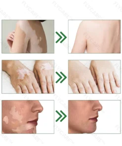 FLYCARE™ Squalene Vitiligo Treatment Cream