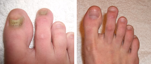 AEXZR™ Toe Nail Treatment Gel