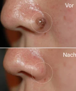 Dobshow™ AraneaCare Skin Blemish Remover