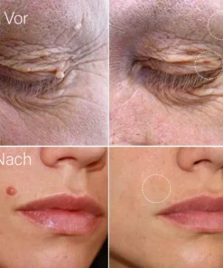 Dobshow™ AraneaCare Skin Blemish Remover