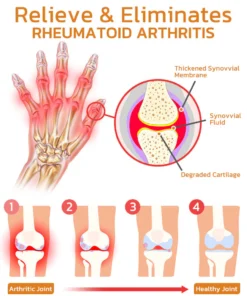 Dobshow™ Bee Venom Joint & Bone Therapy Spray
