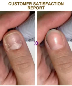 Dobshow™ Fungus-Free Bee Venom Nail Treatment Serum