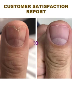 Dobshow™ Fungus-Free Bee Venom Nail Treatment Serum