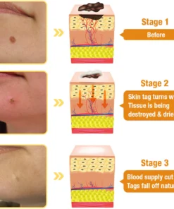 FLYCARE™ Bee Venom Tags & Moles Remover