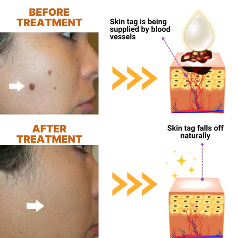 FLYCARE™ Organic Skin Tag Solution