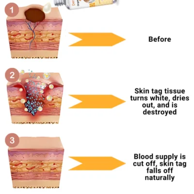 FLYCARE™ Organic Skin Tag Solution