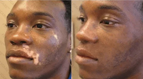 FLYCARE™ Snake Venom Vitiligo Treatment Cream
