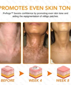 FLYCARE™ Snake Venom Vitiligo Treatment Cream