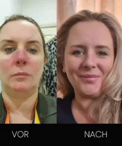 Fivfivgo™ BeeDox Respiremedy Nasal Beruhigendes Instrument