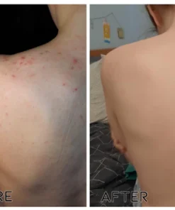 Fivfivgo™ BeeVenom Reinigungslotion für Akne & Pickel & Akanthose Nigricans