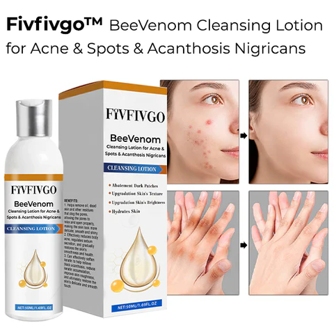 Fivfivgo™ BeeVenom Reinigungslotion für Akne & Pickel & Akanthose Nigricans
