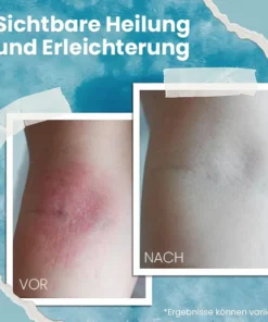 Fivfivgo™ Natürliche Beruhigende Creme für Ekzeme aus dem Ozean