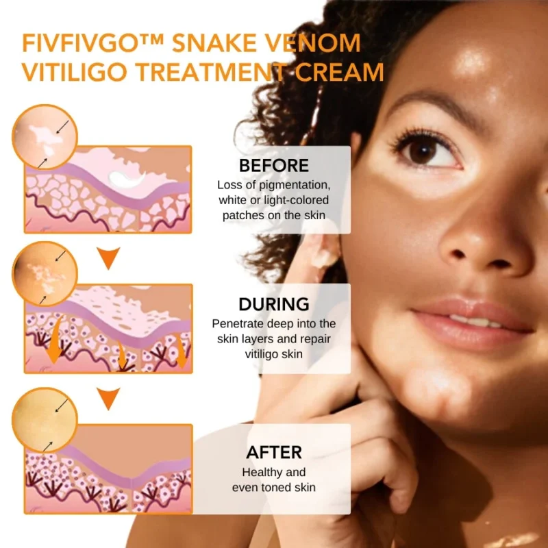 Fivfivgo™ Schlangengift Vitiligo Behandlung Creme