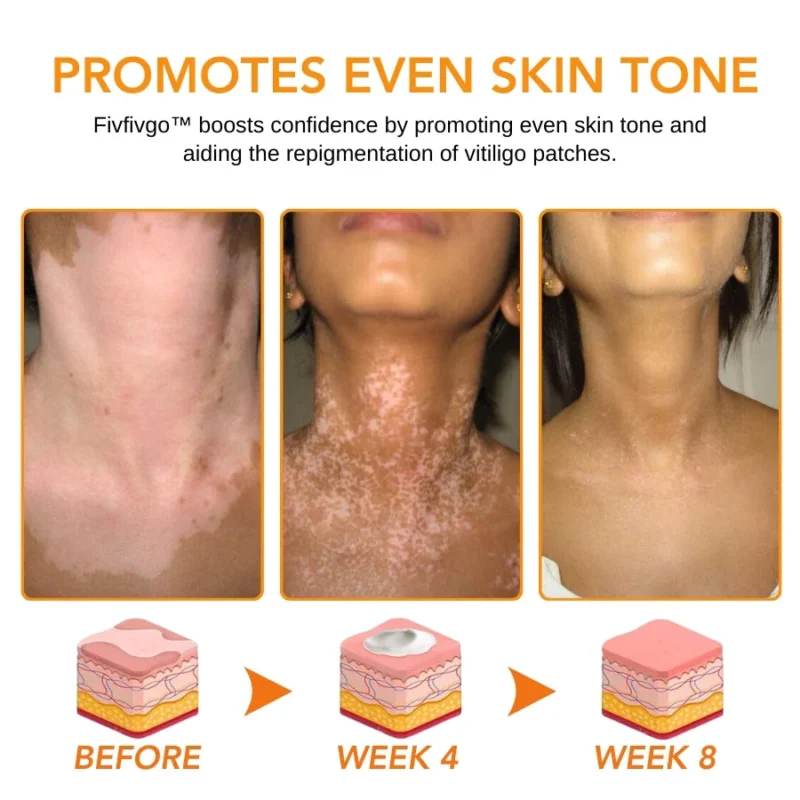 Fivfivgo™ Schlangengift Vitiligo Behandlung Creme