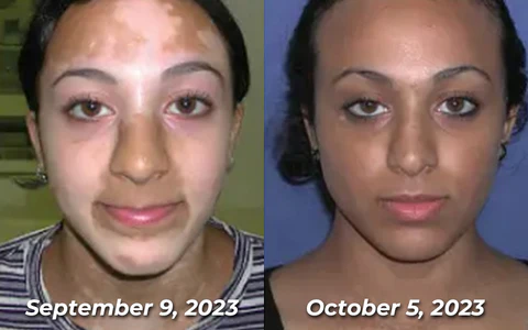 Flycare™ VitiGO Bee Venom Therapy Spray