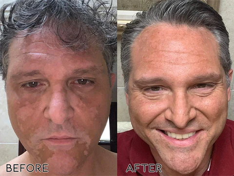 Flycare™ VitiGO Bee Venom Therapy Spray