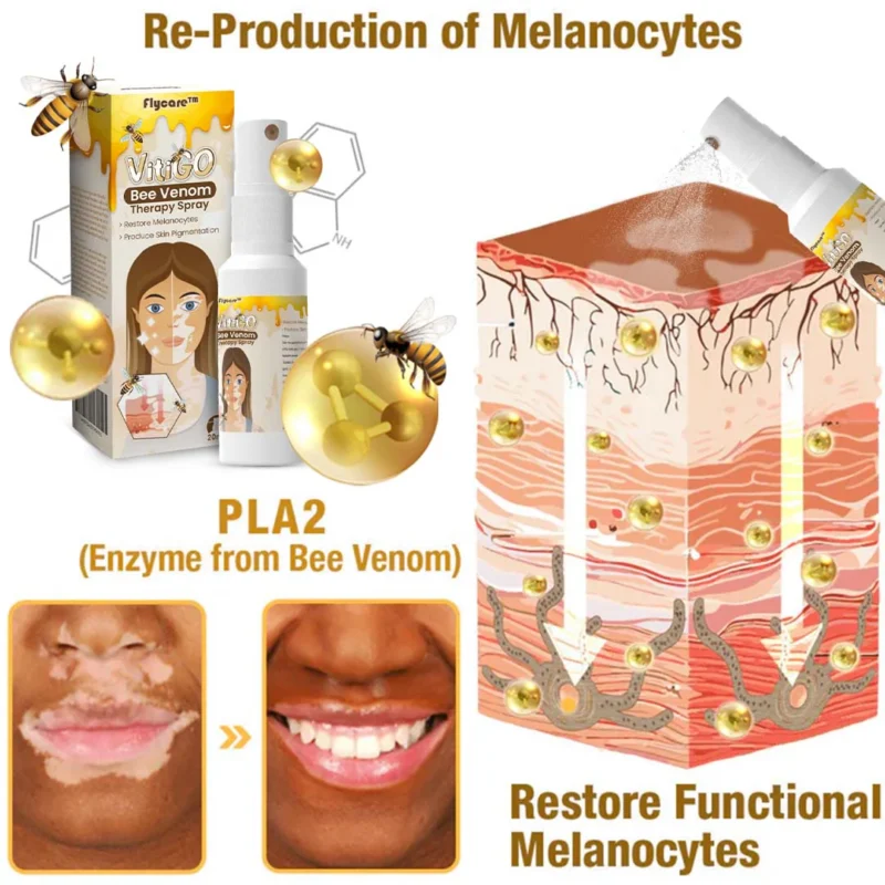 Flycare™ VitiGO Bee Venom Therapy Spray