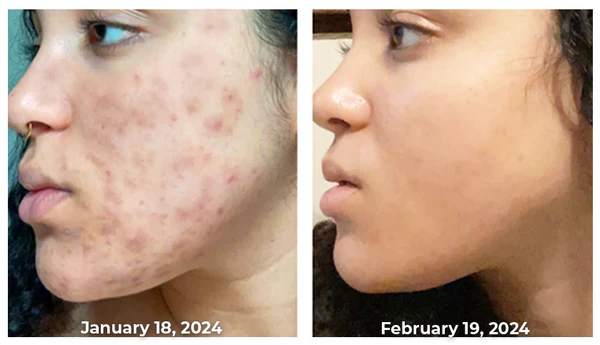 Flysmus™ KojiWhite Kojic Acid Dark Spot Corrector Soap