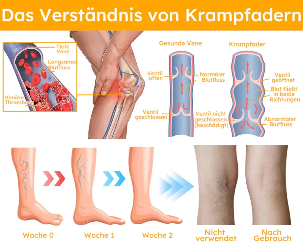 Furzero™ Bienengift-Krampfadern-Spray
