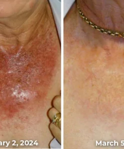 Furzero™ Cleartosis Bee Venom Keratosis Pilaris Spray