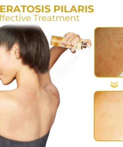 Alternative view of Furzero™ Cleartosis Bee Venom Keratosis Pilaris Spray