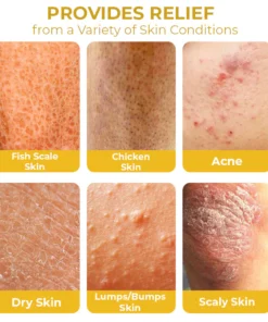 Furzero™ Cleartosis Bee Venom Keratosis Pilaris Spray