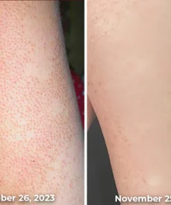 Furzero™ Cleartosis Bee Venom Keratosis Pilaris Spray