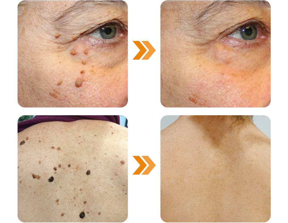 Furzero™ Tagless Bee Venom Treatment Cream