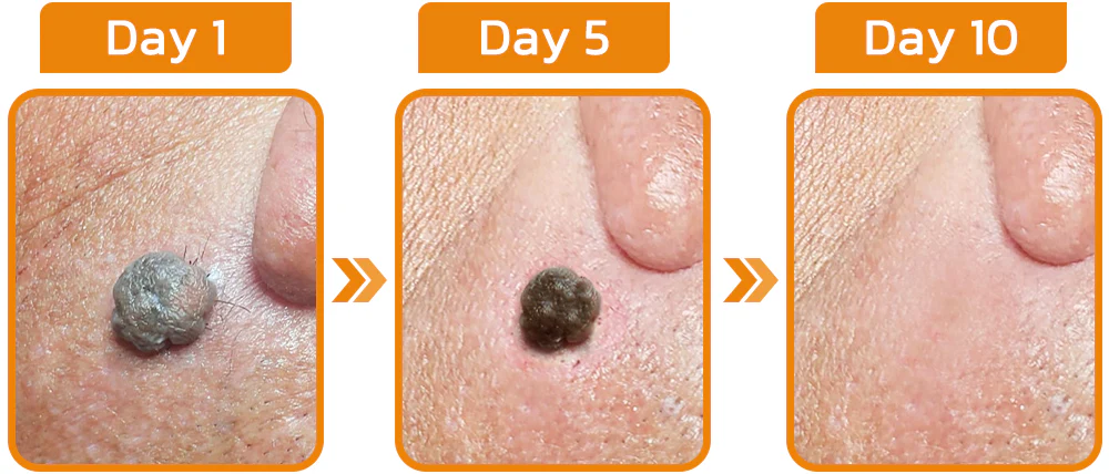 Furzero™ Tagless Bee Venom Treatment Cream