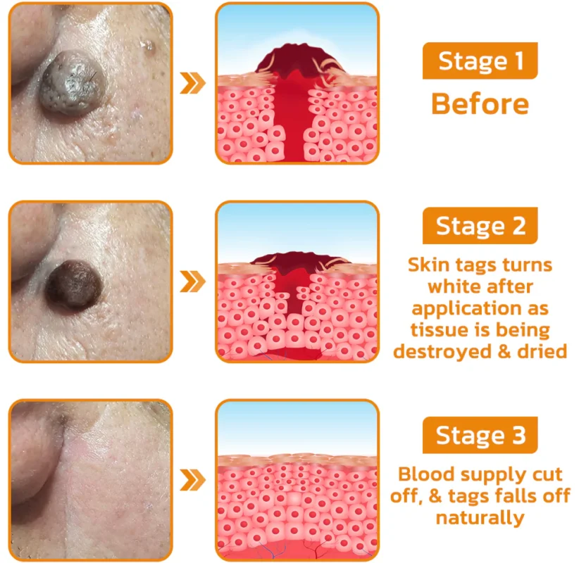 Furzero™ Tagless Bee Venom Treatment Cream