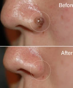 Oveallgo™ AraneaCare Flawless Hautfleckenentferner