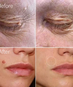 Oveallgo™ AraneaCare Flawless Hautfleckenentferner