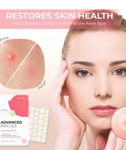 Oveallgo™ PowerClear Advanced Acne Pimple Patches
