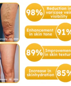 Unpree™ Bees Venom Varicose Veins Cream
