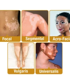 flysmus™ VitiGO Bienengift Behandlungscreme