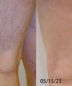 Unpree™ Bees Venom Varicose Veins Cream