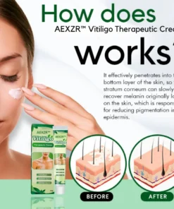 AEXZR™ Vitiligo Therapeutic Cream